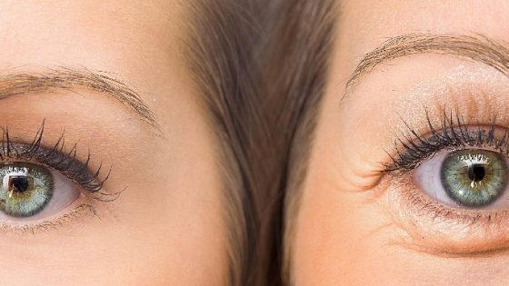 How to get rid of sunken eyes naturally